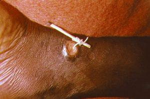 parasite-treatment